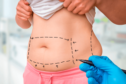 Abdominoplastia valor