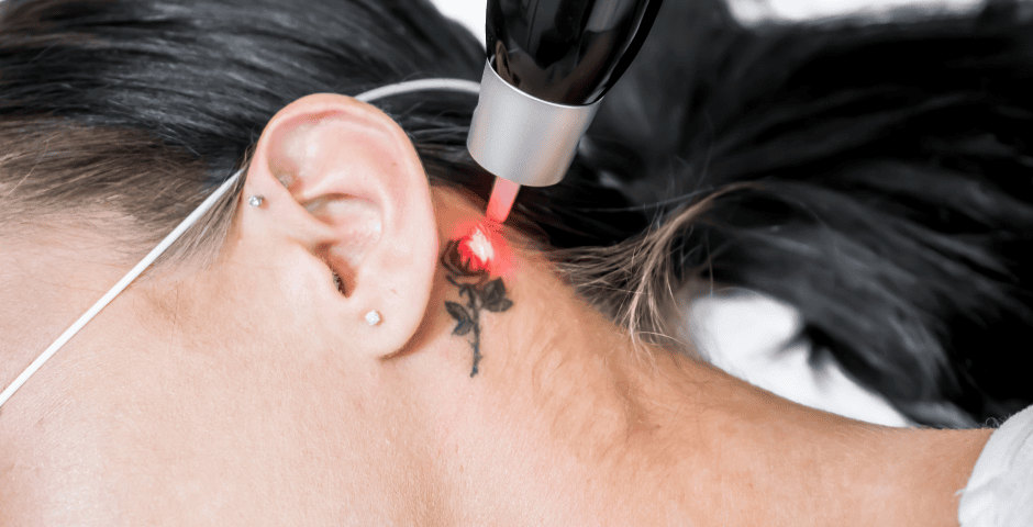 mulher fazendo remoção de tatuagem