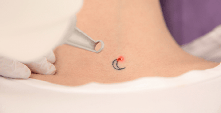 remoção de tatuagem a laser
